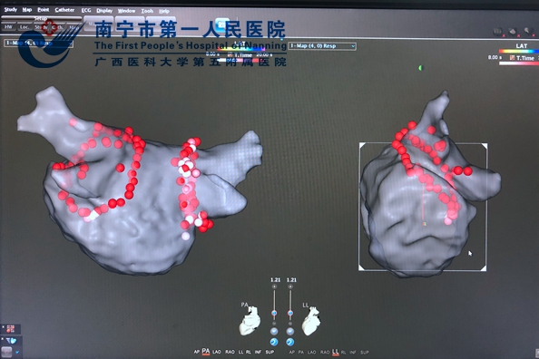 左房环两侧肺静脉逐点消融.jpg