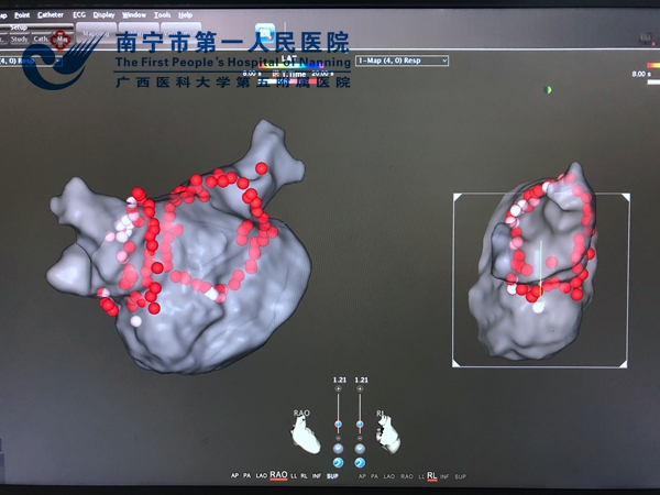 左房环两侧肺静脉逐点消融(2).jpg