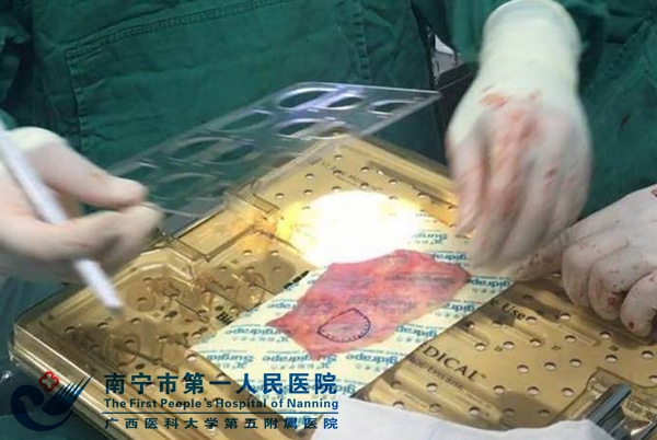 切除的自体心包进行固定测量.jpg