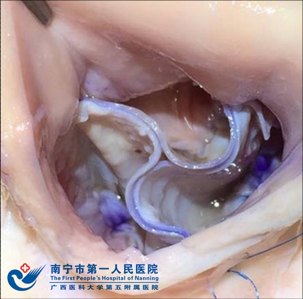 自体心包成形后的主动脉瓣瓣膜.jpg