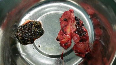 胆囊结石并胆囊炎.jpg