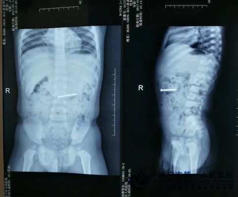 X光片铁钉在体内位置投影.jpg