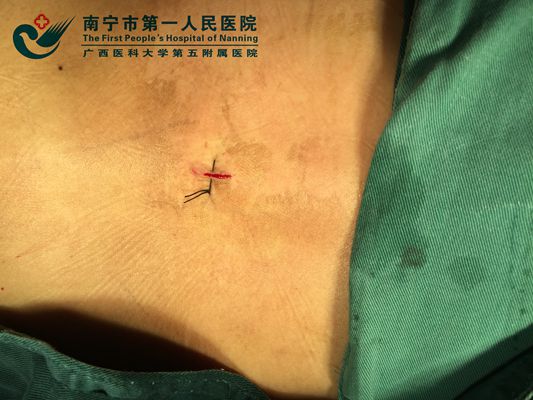 3.仅为7毫米的手术切口.jpg