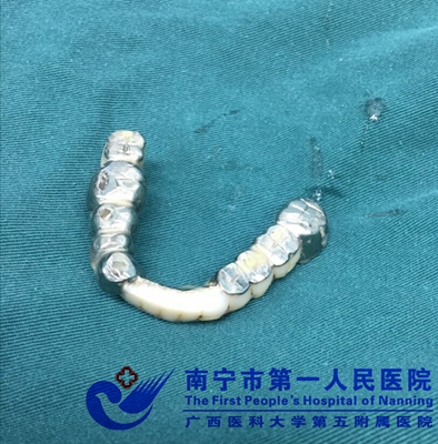 1.误吞的假牙.jpg