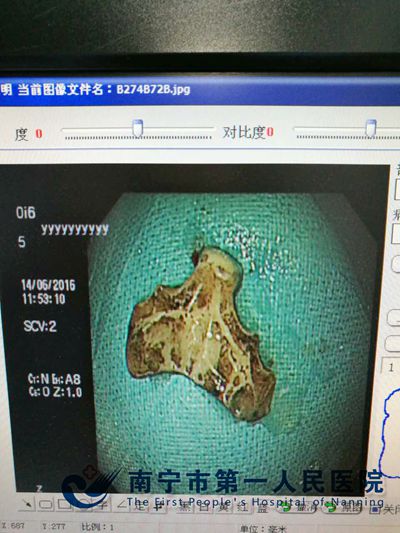 取出的异物.jpg