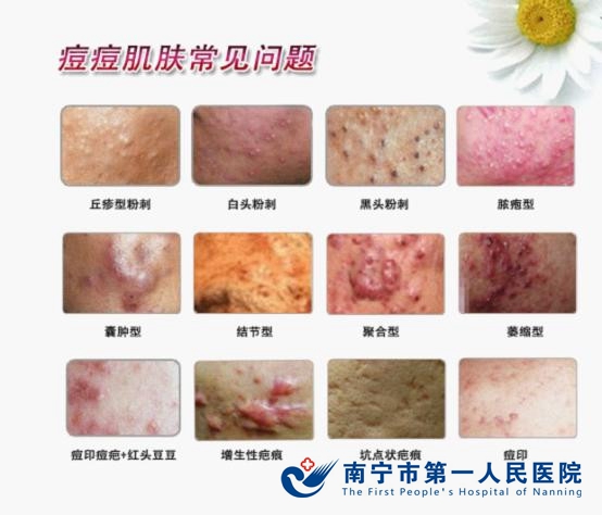 图1:痘痘肌肤常见的问题.jpg