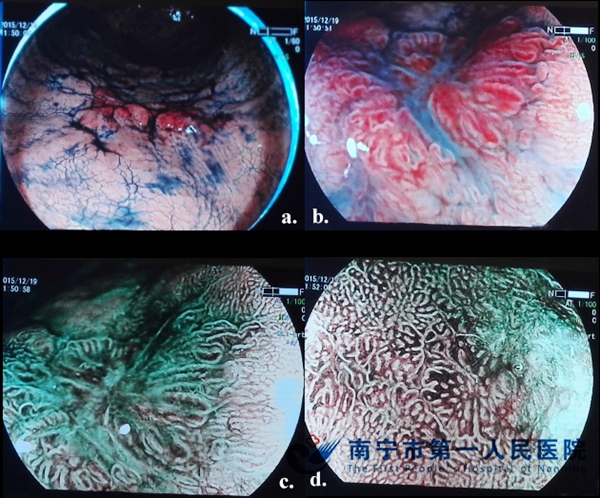 图片2. LASEREO蓝激光内窥镜系统观察早期胃癌病灶.jpg