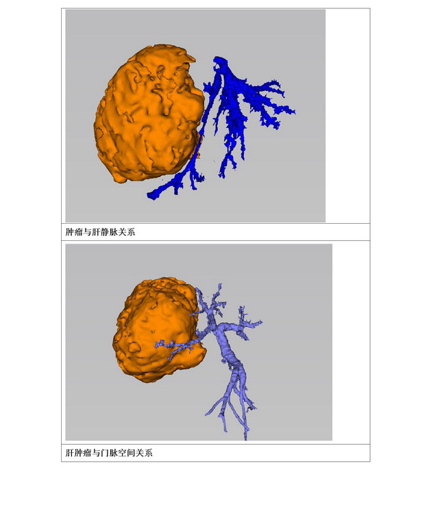 数字医学在肝胆胰腺外科的临床应用05.jpg