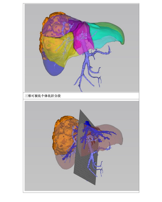 数字医学在肝胆胰腺外科的临床应用06.jpg