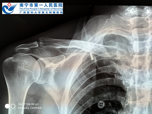 图2:患者术前X片.jpg