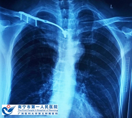 图3:患者术后X片.jpg