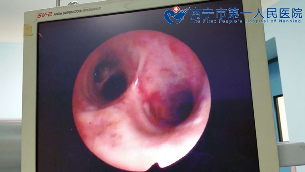 气道异物清除后气管恢复通畅.jpg