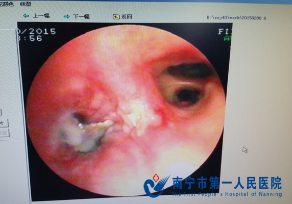 气管镜下显现的鸡骨头.jpg