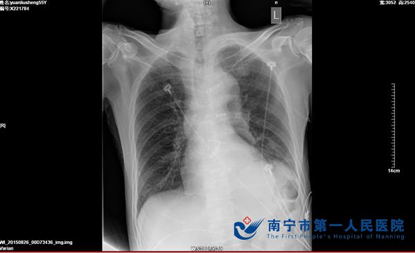气管狭窄前_看图王.jpg