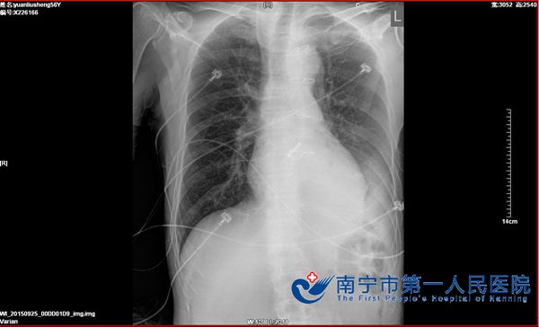 气管狭窄术后_看图王.jpg